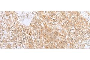 Immunohistochemistry of paraffin-embedded Human lung cancer tissue using ZNF34 Polyclonal Antibody at dilution of 1:40(x200)