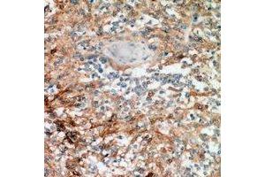 Immunohistochemical analysis of Nanos 1 staining in human breast cancer formalin fixed paraffin embedded tissue section. (Nanos Homolog 1 抗体)