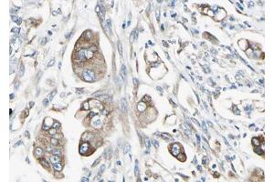 ABIN6267549 at 1/100 staining human Stomach cancer tissue sections by IHC-P. (STAT5B 抗体  (pSer731))
