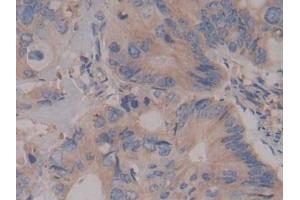 Detection of Rock2 in Human Colorectal cancer Tissue using Polyclonal Antibody to Rho Associated Coiled Coil Containing Protein Kinase 2 (Rock2) (ROCK2 抗体  (AA 904-1140))