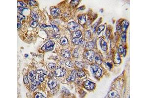 IHC analysis of FFPE human lung carcinoma tissue stained with GRB2 antibody (GRB2 抗体  (AA 187-216))