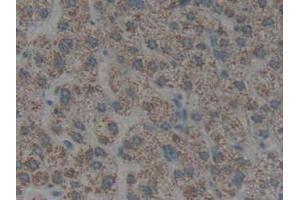 IHC-P analysis of Human Liver Cancer Tissue, with DAB staining. (Cytokeratin 1 抗体  (AA 487-644))