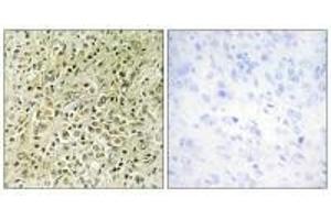 Immunohistochemistry analysis of paraffin-embedded human prostate carcinoma tissue, using RHG07 antibody. (DLC1 抗体)