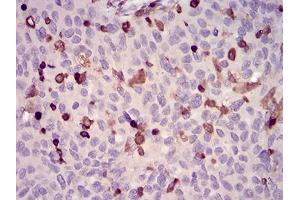 Immunohistochemical analysis of paraffin-embedded ovarian cancer tissues using WAS mouse mAb with DAB staining. (WASP 抗体  (AA 57-170))