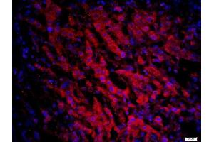 Paraformaldehyde-fixed, paraffin embedded human liver cancer, Antigen retrieval by boiling in sodium citrate buffer (pH6) for 15min, Block endogenous peroxidase by 3% hydrogen peroxide for 20 minutes, Blocking buffer (normal goat serum) at 37°C for 30min, Antibody incubation with CCR6 Polyclonal Antibody, Unconjugated  at 1:200 overnight at 4°C, followed by a conjugated secondary -AF594) at [1:500] for 90 minutes and DAPI staining of the nuclei. (CCR6 抗体  (AA 201-300))