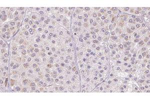 ABIN6277547 at 1/100 staining Human melanoma tissue by IHC-P. (AZGP1 抗体  (Internal Region))