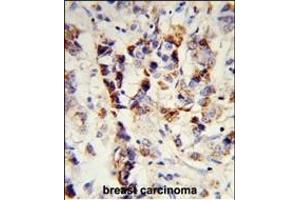 Formalin-fixed and paraffin-embedded human breast carcinoma reacted with SKIV2L2 Antibody (Center), which was peroxidase-conjugated to the secondary antibody, followed by DAB staining. (MTR4 抗体  (AA 237-263))