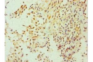 Immunohistochemistry of paraffin-embedded human breast cancer using ABIN7152857 at dilution of 1:100 (FGFBP1 抗体  (AA 24-234))