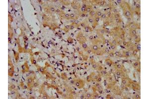 IHC image of ABIN7145800 diluted at 1:800 and staining in paraffin-embedded human liver cancer performed on a Leica BondTM system. (BAZ2B 抗体  (AA 139-240))