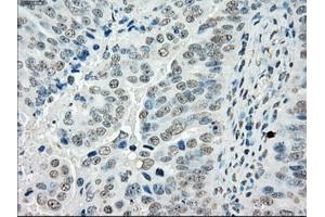 Immunohistochemical staining of paraffin-embedded Adenocarcinoma of colon tissue using anti-PORmouse monoclonal antibody. (POR 抗体)