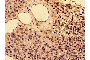 Immunohistochemistry of paraffin-embedded human glioma using ABIN7156842 at dilution of 1:100 (CD25 抗体  (AA 22-185))