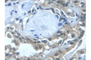 Detection of TGFa in Human Thyroid cancer Tissue using Monoclonal Antibody to Transforming Growth Factor Alpha (TGFa) (TGFA 抗体  (AA 24-98))