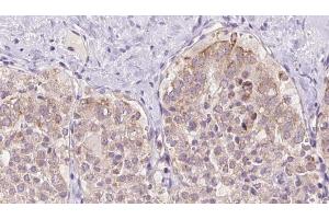 ABIN6273341 at 1/100 staining Human thyroid cancer tissue by IHC-P.
