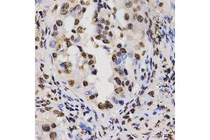 Immunohistochemistry of paraffin-embedded human lung cancer tissue using H3R17me2a antibody at dilution of 1:200 (x400 lens) (Histone 3 抗体  (H3R17me2a))