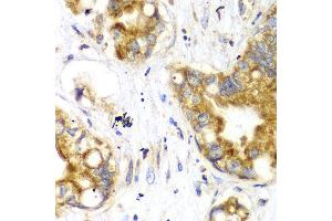 Immunohistochemistry of paraffin-embedded human liver cancer using TOMM20 antibody at dilution of 1:100 (x40 lens). (TOMM20 抗体)