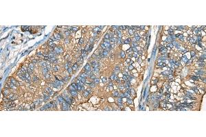 Immunohistochemistry of paraffin-embedded Human gastric cancer tissue using CEACAM8 Polyclonal Antibody at dilution of 1:30(x200) (CEACAM8 抗体)