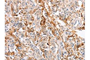 The image on the left is immunohistochemistry of paraffin-embedded Human gastric cancer tissue using ABIN7131059(SIGLEC9 Antibody) at dilution 1/30, on the right is treated with fusion protein. (SIGLEC9 抗体)