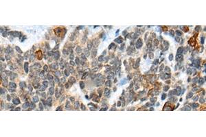 Immunohistochemistry of paraffin-embedded Human thyroid cancer tissue using ATRX Polyclonal Antibody at dilution of 1:50(x200) (ATRX 抗体)