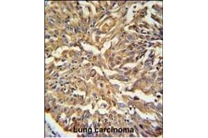 KRT19 Antibody (C-term) (ABIN389327 and ABIN2839443) IHC analysis in formalin fixed and paraffin embedded human Lung carcinoma followed by peroxidase conjugation of the secondary antibody and DAB staining. (Cytokeratin 19 抗体  (C-Term))