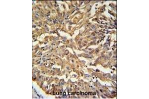 KRT19 Antibody (C-term) (ABIN389327 and ABIN2839443) IHC analysis in formalin fixed and paraffin embedded human Lung carcinoma followed by peroxidase conjugation of the secondary antibody and DAB staining.