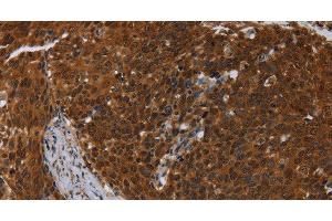 Immunohistochemistry of paraffin-embedded Human cervical cancer using MCHR1 Polyclonal Antibody at dilution of 1:30 (MCHR1 抗体)