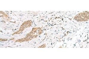 Immunohistochemistry of paraffin-embedded Human esophagus cancer tissue using ENSA Polyclonal Antibody at dilution of 1:40(x200) (Ensa 抗体)
