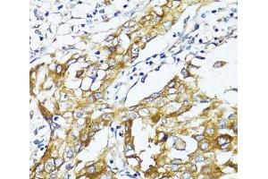 Immunohistochemistry of paraffin-embedded Human liver cancer using GLUT4 Polyclonal Antibody at dilution of 1:100 (40x lens). (GLUT4 抗体)