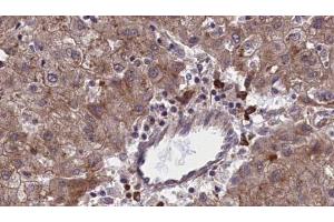 ABIN6273966 at 1/100 staining Human liver cancer tissue by IHC-P. (OR1F1 抗体  (C-Term))