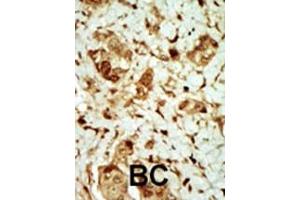 Formalin-fixed and paraffin-embedded human cancer tissue reacted with the primary antibody, which was peroxidase-conjugated to the secondary antibody, followed by DAB staining. (PRKAG3 抗体  (AA 148-178))