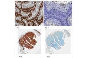 Formalin Fixed Paraffin Embedded (FFPE) human colon adenocarcinoma tissues (Fig. (PCNA 抗体)