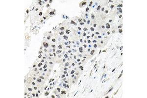 Immunohistochemistry of paraffin-embedded human lung cancer using CDCA8 antibody at dilution of 1:100 (x40 lens). (CDCA8 抗体)