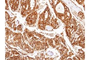 IHC-P Image Immunohistochemical analysis of paraffin-embedded human tyroid cancer, using PPP2R5D, antibody at 1:100 dilution. (PPP2R5D 抗体  (C-Term))