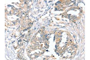 The image on the left is immunohistochemistry of paraffin-embedded Human cervical cancer tissue using ABIN7192539(SLC9A9 Antibody) at dilution 1/45, on the right is treated with synthetic peptide. (SLC9A9 抗体)