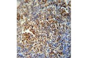 Immunohistochemistry analysis in formalin fixed and paraffin embedded human lung carcinoma reacted with MAF1 Antibody (Center) followed which was peroxidase conjugated to the secondary antibody and followed by DAB staining. (MAF1 抗体  (Middle Region))