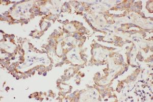 Anti-Galectin 3 Picoband antibody,  IHC(P): Human Lung Cancer Tissue (Galectin 3 抗体  (AA 139-250))