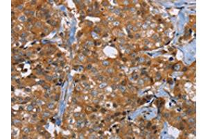 The image on the left is immunohistochemistry of paraffin-embedded Human breast cancer tissue using ABIN7191755(P2RY1 Antibody) at dilution 1/40, on the right is treated with synthetic peptide. (P2RY1 抗体)