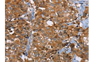 The image on the left is immunohistochemistry of paraffin-embedded Human breast cancer tissue using ABIN7191755(P2RY1 Antibody) at dilution 1/40, on the right is treated with synthetic peptide. (P2RY1 抗体)