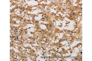 Immunohistochemistry of Human thyroid cancer using DAB2 Polyclonal Antibody at dilution of 1:30 (DAB2 抗体)