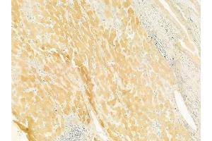 ABIN6260827 and ABIN6279610 at 1/100 staining human hepatocellular carcinoma by IHC-P.