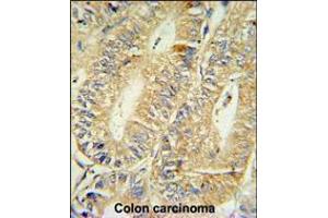 HPGD Antibody IHC analysis in formalin fixed and paraffin embedded human colon carcinoma followed by peroxidase conjugation of the secondary antibody and DAB staining. (HPGD 抗体  (C-Term))