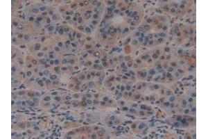 IHC-P analysis of Human Liver Cancer Tissue, with DAB staining. (PTF1A 抗体  (AA 177-328))