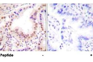 Immunohistochemical analysis of paraffin-embedded human lung carcinoma tissue using ETS1 polyclonal antibody . (ETS1 抗体)