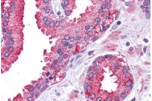 Immunohistochemistry (Formalin-fixed Paraffin-embedded Sections) (IHC (fp)) image for anti-Signal Transducer and Activator of Transcription 3 (Acute-Phase Response Factor) (STAT3) (N-Term) antibody (ABIN6745716)