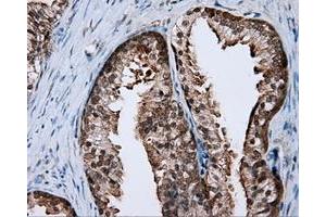 Immunohistochemical staining of paraffin-embedded Carcinoma of liver tissue using anti-RALBP1 mouse monoclonal antibody. (RALBP1 抗体)