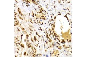 Immunohistochemistry of paraffin-embedded human adenomyosis using HMGB1 Antibody. (HMGB1 抗体  (AA 100-200))