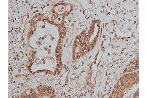 ABIN6268858 at 1/50 staining human colon cancer tissue sections by IHC-P. (MCL-1 抗体  (Internal Region))