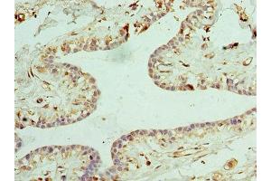 Immunohistochemistry of paraffin-embedded human breast cancer using ABIN7147858 at dilution of 1:100 (CLTA 抗体  (AA 1-218))