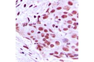 Immunohistochemical analysis of MCM2 staining in human breast cancer formalin fixed paraffin embedded tissue section. (MCM2 抗体  (N-Term))