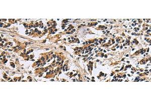 Immunohistochemistry of paraffin-embedded Human breast cancer tissue using DIAPH2 Polyclonal Antibody at dilution of 1:55(x200) (DIAPH2 抗体)