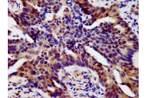 IHC image of ABIN7155739 diluted at 1:500 and staining in paraffin-embedded human lung cancer performed on a Leica BondTM system. (HOXB4 抗体  (AA 88-166))